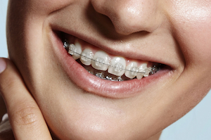 appareil dentaire - brackets en ceramique