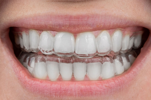 appareil dentaire - gouttieres aligner 