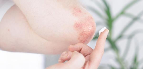 L’eczéma, peut-on l’éviter ? Comment le traiter ?