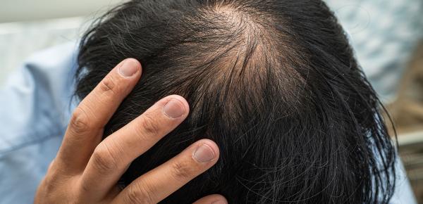 chute-cheveux-hommes-calvitie