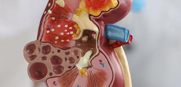 Prévenir et traiter la cystite : ce qu'il faut savoir