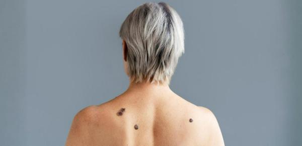 grains beauté surveiller cancer peau