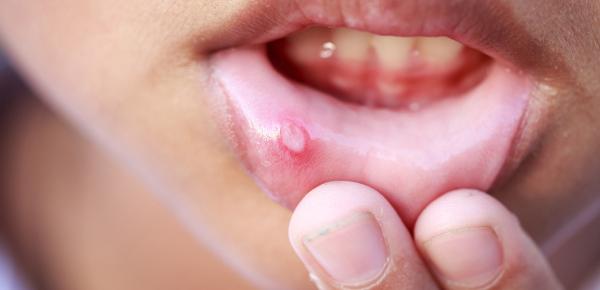 Aphtes dans la bouche : causes et solutions pour les traiter