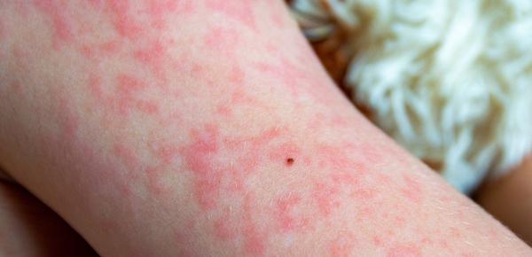 Rugeole adulte vaccin