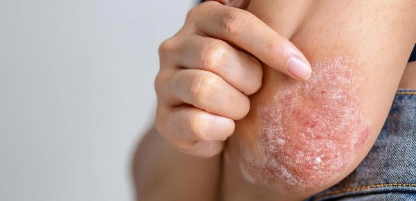 Traitement du psoriasis : comprendre, soigner et mieux vivre la maladie