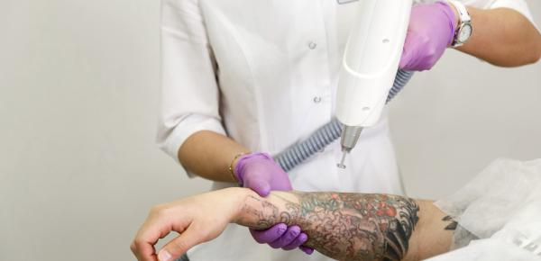 enlever un tatouage au laser