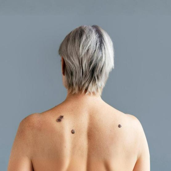 grains beauté surveiller cancer peau