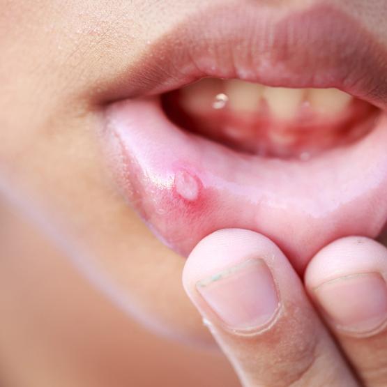 Aphtes dans la bouche : causes et solutions pour les traiter