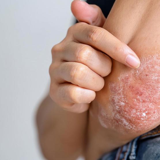 Traitement du psoriasis : comprendre, soigner et mieux vivre la maladie