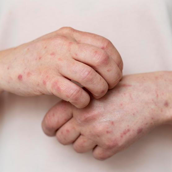 Monkeypox - variole du singe