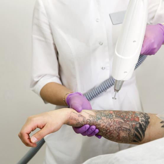 enlever un tatouage au laser
